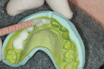 Figure 11  To create the provisional restorations,a putty matrix was filled with shade BL ofthe temporary material.