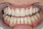 Figure 13  Close-up retracted view of the completedprovisional restorations, which achieved all of thetreatment goals and were approved of by the patient.