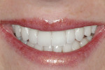 Figure 15  Postoperative close-up view of thepatient in natural smile. Note the enhancedtooth display and decreased negative space inthe buccal corridors, as well as the enhancedtooth shade.