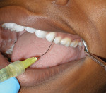 Figure 3  Using the syringe tip, the anestheticcan be delivered directly into the pockets.