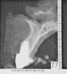 Figure 2  Computed tomography scan. Notethe thin buccal plate, the emergence of the toothfrom the alveolus, and the sufficient volume ofbone to engage an implant.