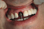 Figure 4  Parallel pin showing the emergence ofthe osteotomy between the lingual fossa andincisal line angle of the contralateral tooth.