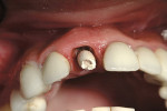 Figure 6  Temporary implant abutment. Notebuccal pouching. (Photograph taken at the 1-weekpostoperative check-up.)