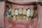 Case 1 retracted view of patient’s dentition.
