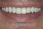 Provisional prosthesis with hidden transition line and esthetic smile line.