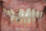 Retracted view of the patient’s dentition.