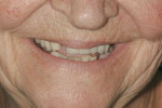 Case 3 exaggerated smile to evaluate gingival and tooth display.