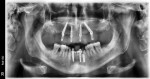 Panoramic radiograph 1 year after treatment showing stable bone levels around well-integrated implants.