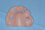 Prefabricated denture drilled in the location of the temporary cylinders, ready for intraoral pick-up.