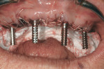 Temporary titanium cylinders in place over multiunit abutments.