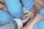 Monoject syringe is used to pick up temporary abutments for better control of the placement of the cold-cure acrylic.