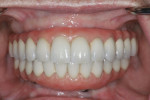 Upper and lower permanent screw-retained prosthesis 1 year after initial implant placement.