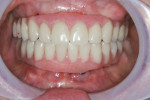 Upper and lower immediately loaded screw-retained prosthesis 1 week after surgery.