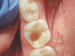 The preparation after full caries lesion excavation and creation of preparation with beveled margins.