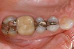 Figure 1  Original condition: amalgams on teethNos. 12, 13, and 15, and a PFM crown on toothNo. 14.