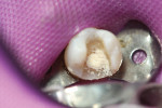 Placement of tricalcium silicate liner/base
(Biodentine, Septodont) serving as a direct/indirect pulp capping agent and base
material, replacing portion of dentin that was removed.
