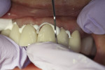 Use of calcium aluminate/glass ionomer luting agent (Ceramir C&B, Doxa Dental AB) to cement six anterior all-zirconia crowns. Note ease of cement removal.
