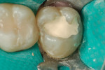 Use of a tricalcium silicate temporary restorative (Biodentine, Septodont; case photography provided by Dr. John Burgess).