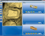 Figure 7  A digital impression of the entirequadrant was taken with the CEREC AC"sBluecam LED acquisition camera.