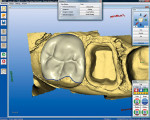 Figure 8  The CEREC AC System automaticallyproposed an onlay restoration design for toothNo. 15.