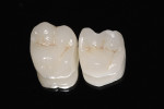 Figure 11  The restorations went through stainand-glaze crystallization to add strength and naturalcharacterization.