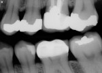 Figure 13  Preoperative radiograph showedamalgams in teeth Nos. 12 through 15.
