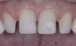Conservative preparation design; preserving enamel is important for long-term success and is best controlled via reduction guides.