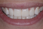 Transfer of digital design to the mouth as a motivational trial smile using provisional material; note improved smile line.