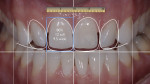 Completed digital generated smile design used for lab and patient communication; this can be emailed or printed and sent to the lab.