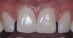 Preoperative four front teeth showing spacing and rotations.