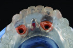 Fig 10 and Fig 11. The clear duplicate is finished and adjusted on the previous implant-level model to accommodate the impression copings.