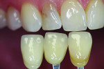Fig 2 and Fig 3. Selected shade tabs are photographed in vertical alignment with the natural teeth prior to preparation.