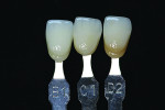 Fig 2 and Fig 3. Selected shade tabs are photographed in vertical alignment with the natural teeth prior to preparation.