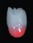 Fig 7. A thin layer of D3 dentin is applied on the gingival one-third.