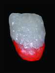Fig 13. After firing, a second layer of dentin, one shade darker than D3, is applied on the gingival one-third to recreate the darker shade commonly found in natural dentition.