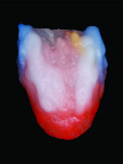 Fig 17. A white blue translucent layer is placed over the mesial and distal line angle areas.