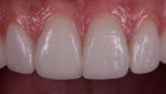 Final restorations harmoniously blending with the existing natural teeth and smile; note excellent marginal fit and tissue response.