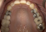 Preoperative maxillary occlusal view displaying erosion, attrition, and structural compromises.