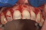 Because the amount of orthodontic intrusion was inadequate with the clear aligner system alone, a full-thickness flap was reflected for esthetic crown lengthening.
