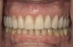 Esthetic mock-up placed over the teeth on the unanesthetized patient for evaluation and as a tooth reduction guide.