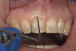 Bone sounding prior to esthetic crown lengthening revealed 2.5 mm measured from the FGM to the osseous crest, indicating a high crest dentogingival complex.
