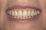 The increase in length both gingivally and incisally deemphasized the gingival display, allowing the smile to properly “frame” the teeth.