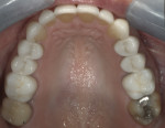 All of the final restorations except for the first molars were delivered with adhesive protocols, as the preparations remained almost completely in enamel.