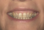 Preoperative full-smile view showing hyper lip mobility, complete tooth display, and high gingival reveal.
