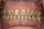 Preoperative view showing the fractured cosmetic bonding and facial recession present on the maxillary posterior teeth.
