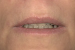Postoperative lips in repose showed just a slight increase in length incisally.