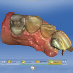 A copy line was drawn around the preoperative tooth structure using the Biocopy function.