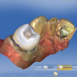 As proposed by the software, the final restoration was an exact replica of the preexisting tooth.