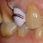 In the blue-stage try-in, it was evident that the partial denture fit identically to how it fit the original tooth.