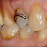 The removable partial denture had a rest seat on the distal aspect and clasps on the buccal and lingual aspects of tooth No. 4.